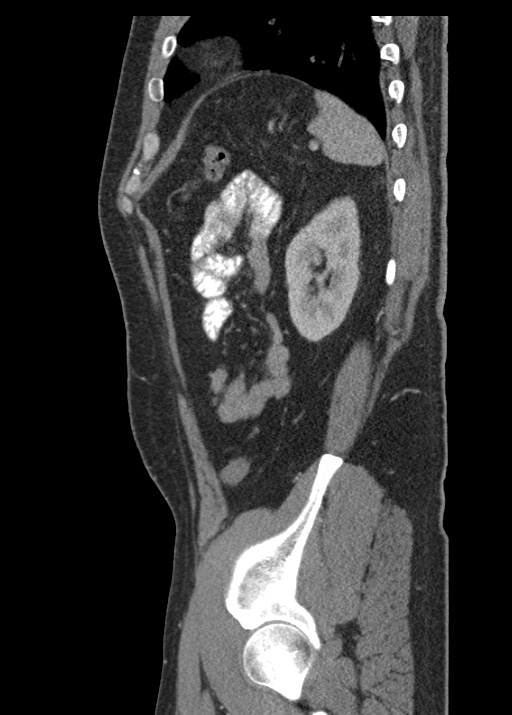 Acute appendicitis (Radiopaedia 48511-53463 Sagittal C+ portal venous phase 103).jpg