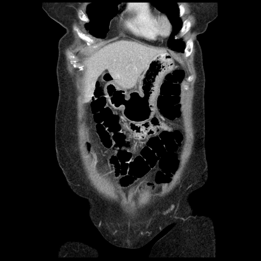 Acute appendicitis (Radiopaedia 52672-58589 Coronal C+ portal venous phase 4).jpg