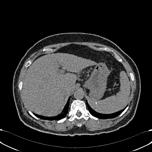 Acute appendicitis (Radiopaedia 58627-65818 Axial non-contrast 20).jpg