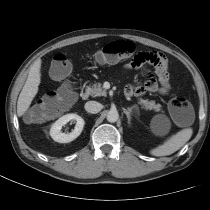 File:Acute appendicitis (Radiopaedia 66513-75790 Axial C+ portal venous phase 20).jpg