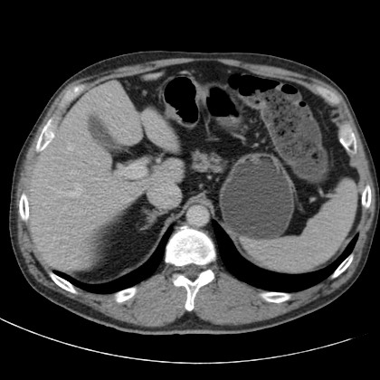 File:Acute appendicitis (Radiopaedia 66513-75790 Axial C+ portal venous phase 9).jpg
