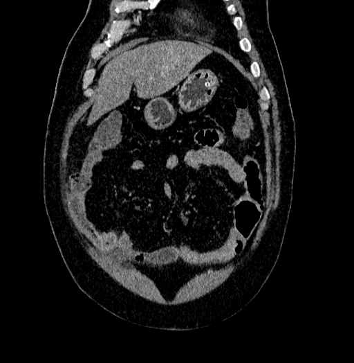 Acute appendicitis (Radiopaedia 79950-93224 Coronal C+ portal venous phase 16).jpg