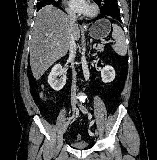 Acute appendicitis (Radiopaedia 79950-93224 Coronal C+ portal venous phase 50).jpg