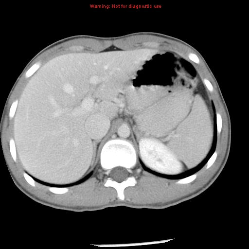 Acute appendicitis (Radiopaedia 8195-9045 Axial C+ portal venous phase 16).jpg
