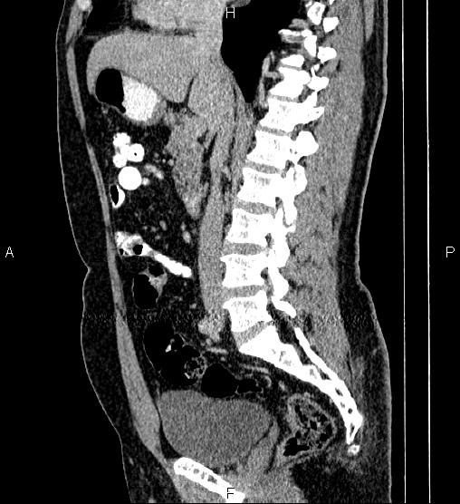 File:Acute appendicitis (Radiopaedia 84780-100240 Sagittal C+ portal venous phase 48).jpg