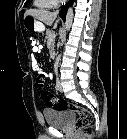 Acute appendicitis (Radiopaedia 84780-100240 Sagittal C+ portal venous phase 52).jpg