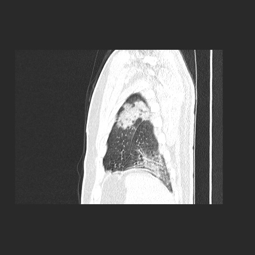 Acute appendicitis and COVID 19 pneumonia (Radiopaedia 76604-88380 Sagittal lung window 83).jpg