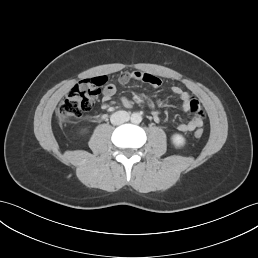 Acute appendicitis with appendicoliths (Radiopaedia 50186-55532 Axial C+ portal venous phase 43).png
