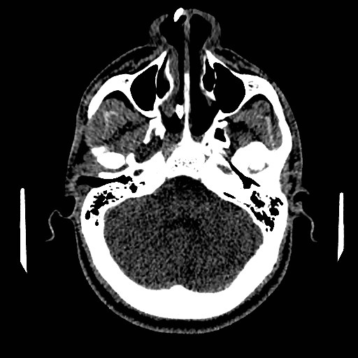 Acute basilar artery occlusion (Radiopaedia 43582-46985 Axial non-contrast 51).jpg