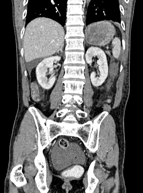 Acute bowel ischemia (Radiopaedia 87695-104114 Coronal C+ portal venous phase 267).jpg