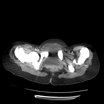Acute calculous cholecystitis in patient with osteopetrosis (Radiopaedia 77871-90159 Axial C+ portal venous phase 79).jpg