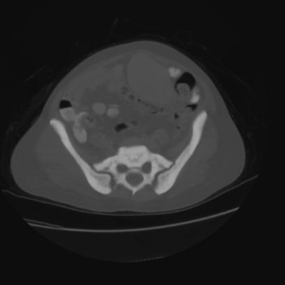 File:Acute calculous cholecystitis in patient with osteopetrosis (Radiopaedia 77871-90159 Axial bone window 37).jpg