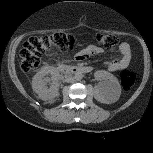 Acute cholecystitis and ureteric colic (Radiopaedia 42330-45444 Axial prone 43).jpg