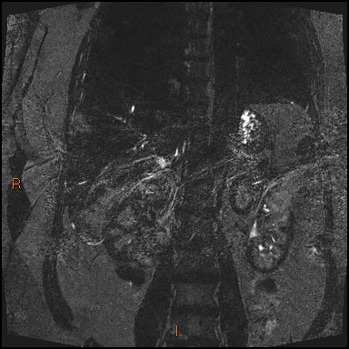 File:Acute cholecystitis with gallbladder neck calculus (Radiopaedia 42795-45971 Coronal Turbo spin echo 7).jpg