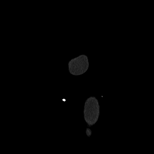 File:Acute cholecystitis with tensile fundus sign (Radiopaedia 71394-81723 Sagittal non-contrast 174).jpg
