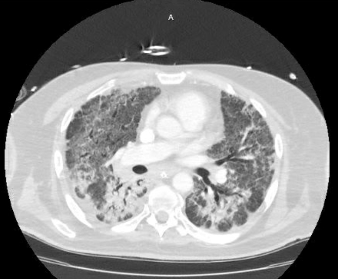 Acute cor pulmonale (ultrasound) (Radiopaedia 83508-98818 Axial lung window 45).jpg