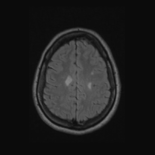 Acute disseminated encephalomyelitis (ADEM) (Radiopaedia 38073-40065 Axial FLAIR 51).png