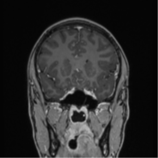 Acute disseminated encephalomyelitis (ADEM) (Radiopaedia 65319-74349 Coronal T1 C+ 38).png