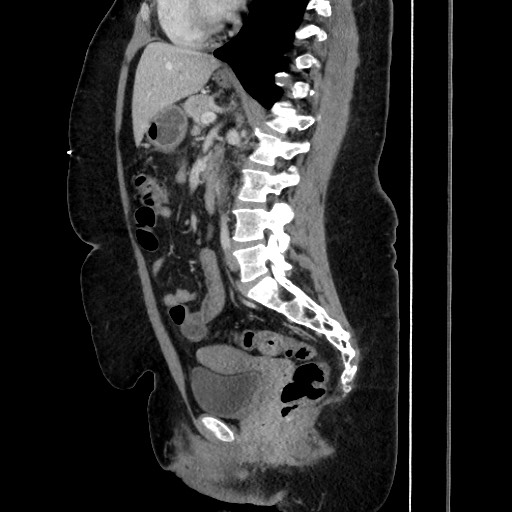 Acute diverticulitis - transverse colon (Radiopaedia 87063-103327 Sagittal C+ portal venous phase 129).jpg