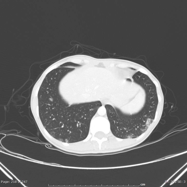 Acute eosinophilic pneumonia (Radiopaedia 48211-53073 Axial lung window 78).jpg