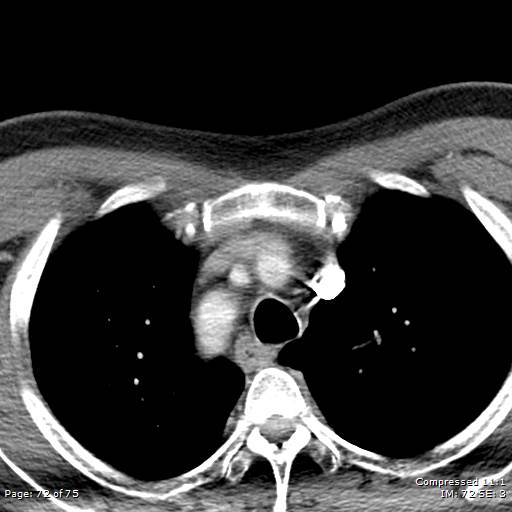 Acute epiglottitis (Radiopaedia 54375-60590 Axial C+ arterial phase 72).jpg
