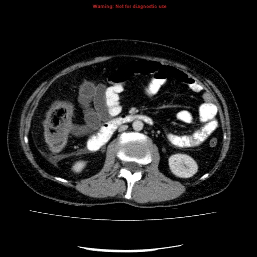 File:Acute gangrenous cholecystitis (Radiopaedia 10123-10661 Axial C+ portal venous phase 48).jpg