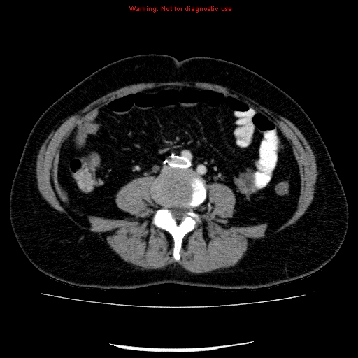 Acute gangrenous cholecystitis (Radiopaedia 10123-10661 Axial C+ portal venous phase 64).jpg