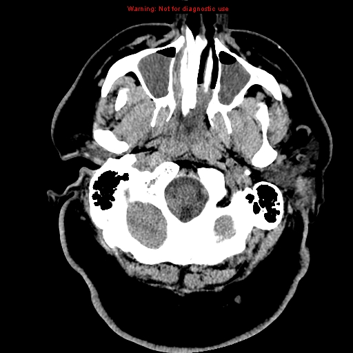 File:Acute hemorrhagic leukoencephalitis (Radiopaedia 14076-13920 Axial non-contrast 2).jpg