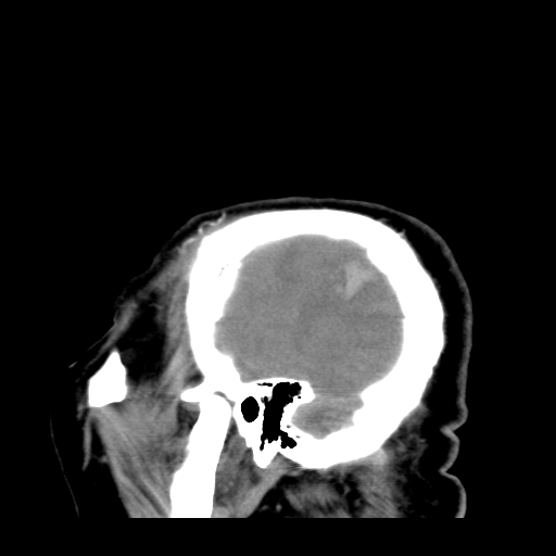 File:Acute hemorrhagic stroke (Radiopaedia 17507-17223 Sagittal non-contrast 5).jpg