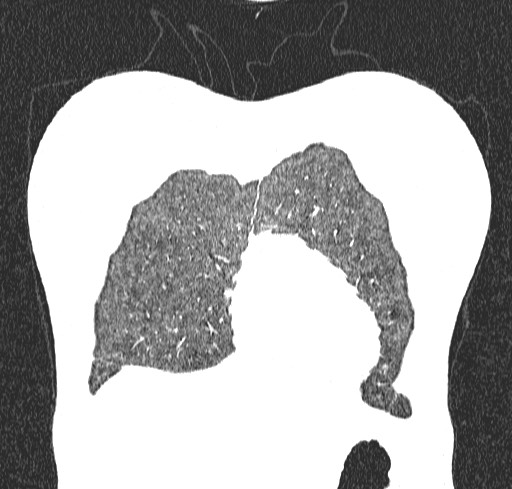 Acute hypersensitivity pneumonitis (Radiopaedia 85293-100870 Coronal lung window 11).jpg