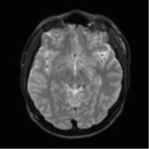Acute left middle cerebral artery territory infarct with clot retrieval (Radiopaedia 47732-52433 Axial DWI 13).png