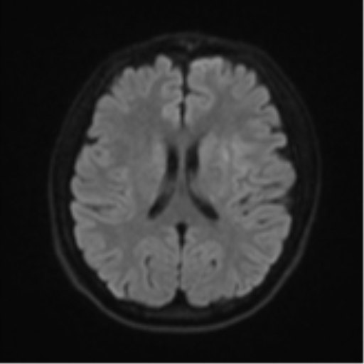 Acute left middle cerebral artery territory infarct with clot retrieval (Radiopaedia 47732-52433 Axial DWI 48).png