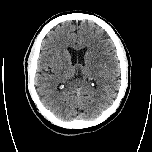 Acute left middle cerebral artery territory ischemic stroke (Radiopaedia 35688-37223 Axial non-contrast 45).png