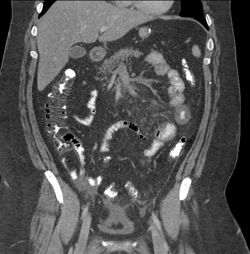 Acute mesenteric venous ischemia (Radiopaedia 46041-50383 Coronal C+ portal venous phase 40).jpg