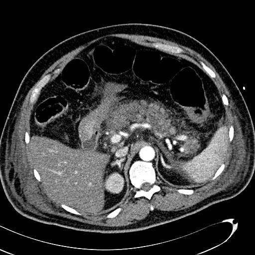File:Acute pancreatic necrosis (Radiopaedia 13560-13486 Axial C+ portal venous phase 49).jpg