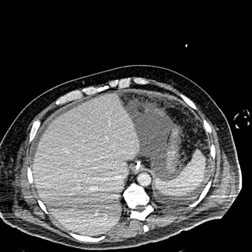 File:Acute pancreatic necrosis (Radiopaedia 13560-18501 Axial C+ portal venous phase 18).jpg