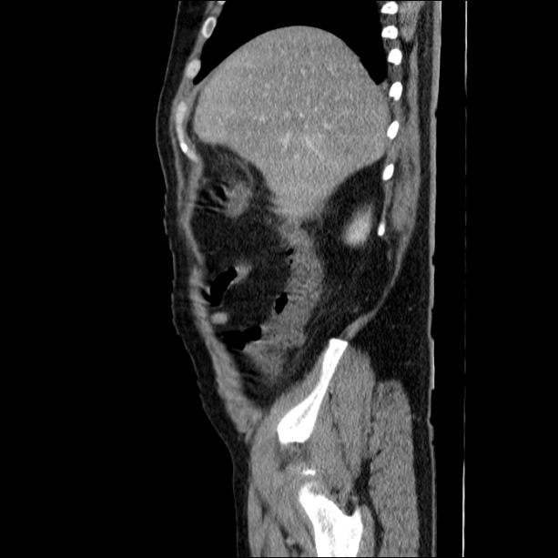 Acute pancreatitis (Radiopaedia 26663-26813 Sagittal C+ portal venous phase 15).jpg