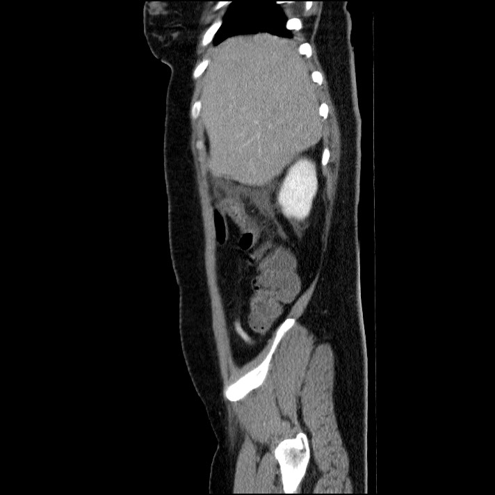 Acute pancreatitis (Radiopaedia 69236-79012 Sagittal C+ portal venous phase 79).jpg