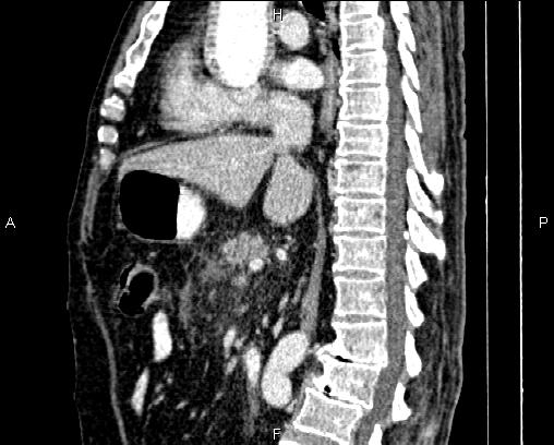 Acute pancreatitis (Radiopaedia 85146-100701 Sagittal C+ portal venous phase 46).jpg