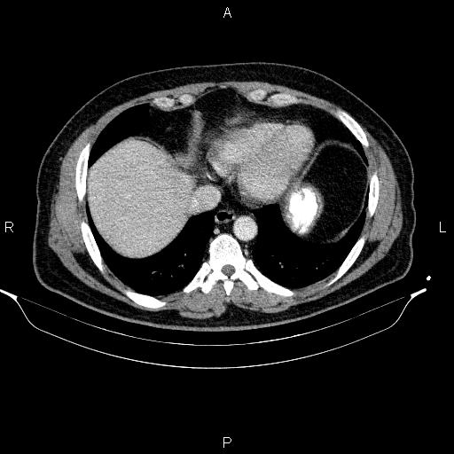 Acute pancreatitis (Radiopaedia 85390-101010 Axial C+ portal venous phase 10).jpg
