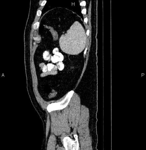 File:Acute pancreatitis (Radiopaedia 85390-101010 Sagittal C+ portal venous phase 92).jpg