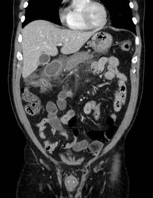 Acute pancreatitis - Balthazar E (Radiopaedia 23080-23110 Coronal C+ portal venous phase 25).jpg