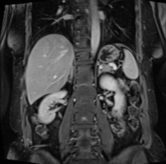 Acute pancreatitis - Balthazar E - post ERCP (Radiopaedia 27562-27778 Coronal T1 C+ fat sat 43).png