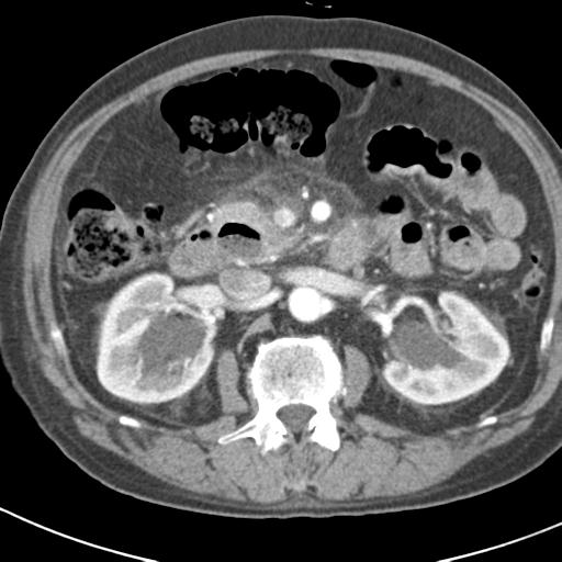 File:Acute pancreatitis and walled-off necrosis (Radiopaedia 29888-30403 Axial C+ portal venous phase 21).jpg