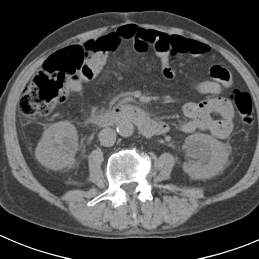 File:Acute pancreatitis and walled-off necrosis (Radiopaedia 29888-30403 Axial non-contrast 36).jpg