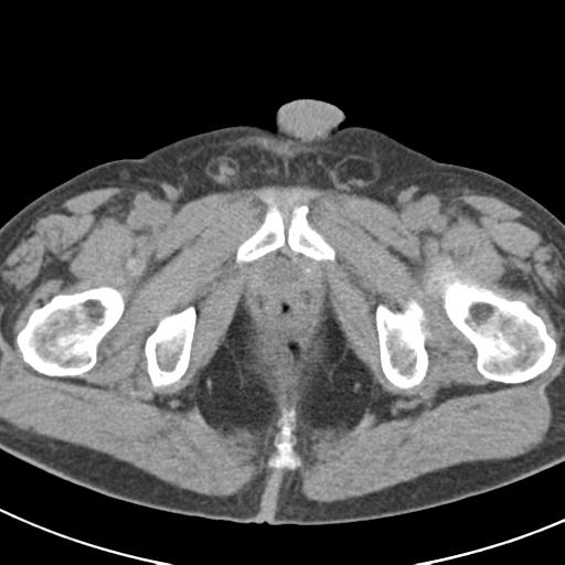 File:Acute pancreatitis and walled-off necrosis (Radiopaedia 29888-30403 Axial non-contrast 78).jpg