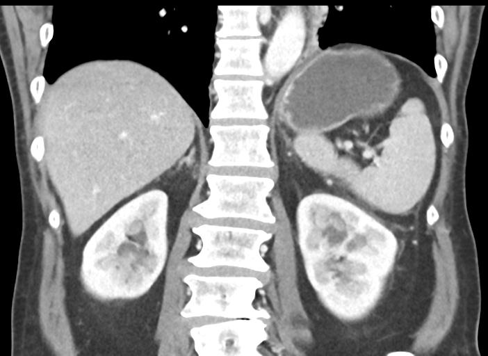 Acute pancreatitis and walled-off necrosis (Radiopaedia 29888-30404 Coronal C+ portal venous phase 37).jpg
