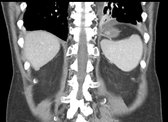 Acute pancreatitis and walled-off necrosis (Radiopaedia 29888-30404 Coronal C+ portal venous phase 42).jpg