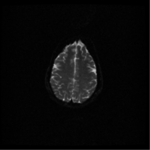 File:Acute pontine infarct from vertebral artery dissection (Radiopaedia 34111-35370 Axial DWI 42).png