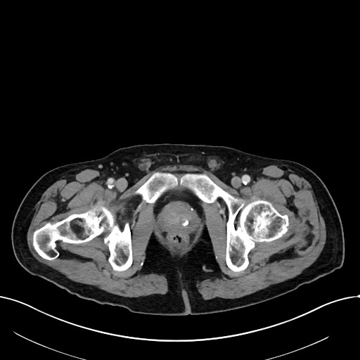 Acute renal infarction (Radiopaedia 59375-66736 Axial C+ portal venous phase 119).jpg